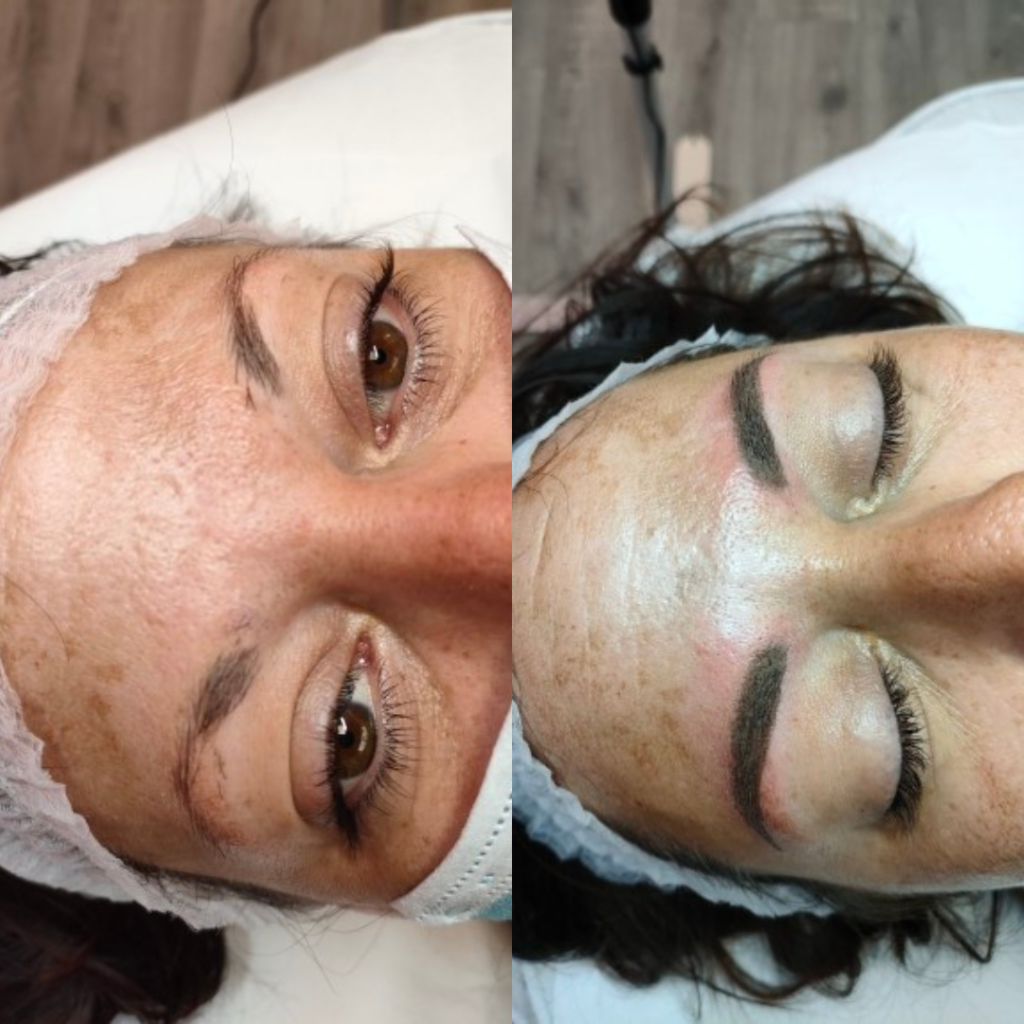 Avant après d'une femme ayant reçu une dermopigmentation des sourcils chez Derm'Ô Beauty