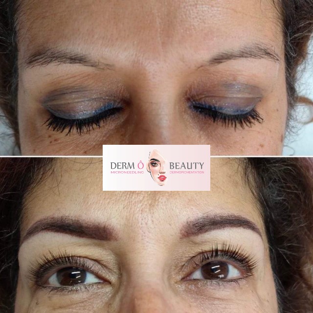 Avant après d'une femme ayant reçu une dermopigmentation des sourcils chez Derm'Ô Beauty